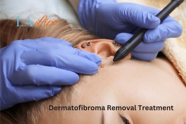 Dermatofibroma Removal Treatment Norwood Green