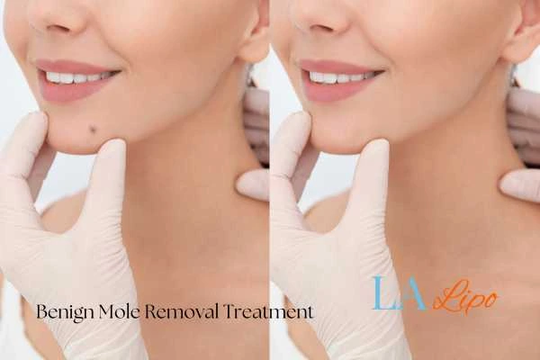 Before-and-after results following benign mole-removal treatment Norwood Green