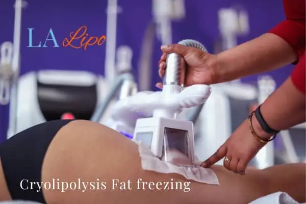 women getting fat freezing Norwood Green