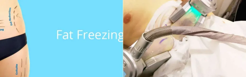 Fat freezing Norwood Green on multiple areas of the body