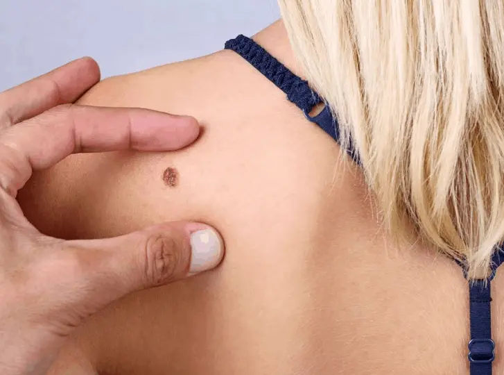 woman having mole removal Norwood Green consultation before treatment.