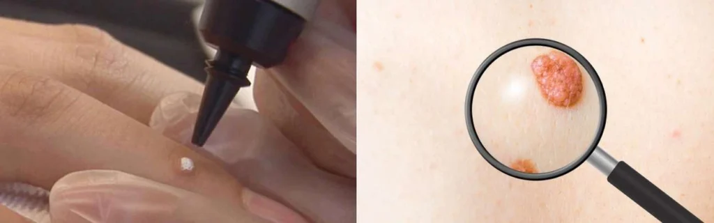 CryoPen practitioner Norwood Green assessing a benign mole before treatment