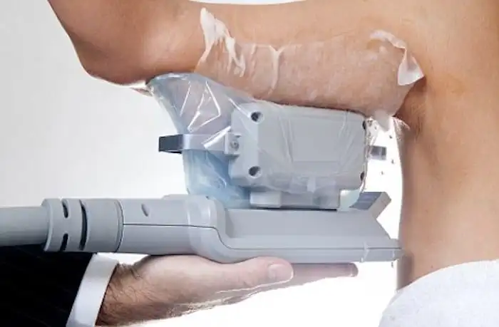 Picture of fat freezing Norwood Green on the upper arms.