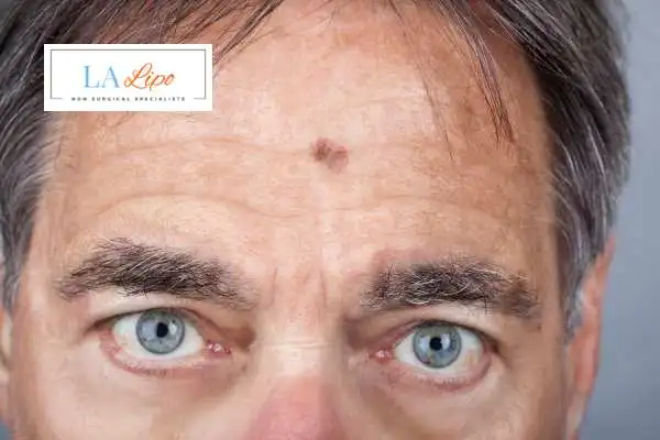 Solar Lentigo Removal Norwood Green image of man with mark on his forehead