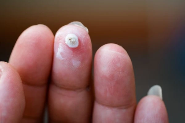 wart on person finger - cryotherapy to treat from LA LIPO Norwood Green