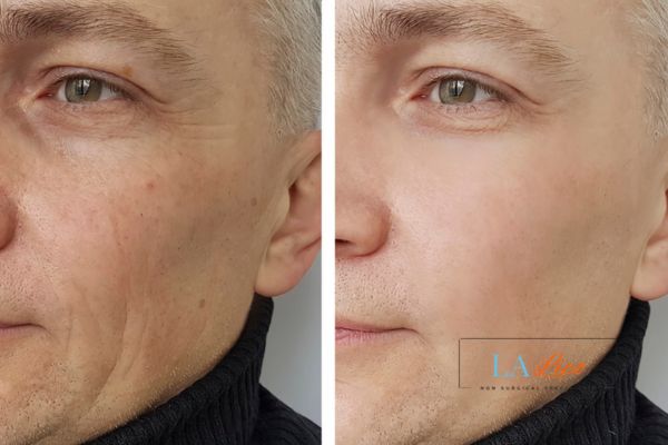 See the amazing results of Morpheus8 Treatment Norwood Green!